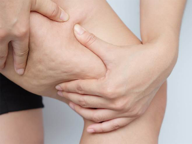 Dez alimentos que auxiliam no combate à celulite - Quem Realiza